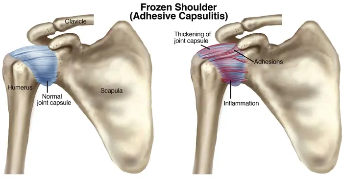 Physical Therapy Guide to Frozen Shoulder (Adhesive Capsulitis)