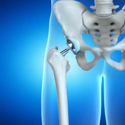 Taking the Pain Out of Hip-Replacement Surgery